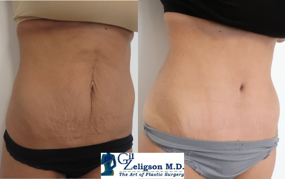 Dr. Gil Zeligson - Tummy Tuck Abdomino plasty