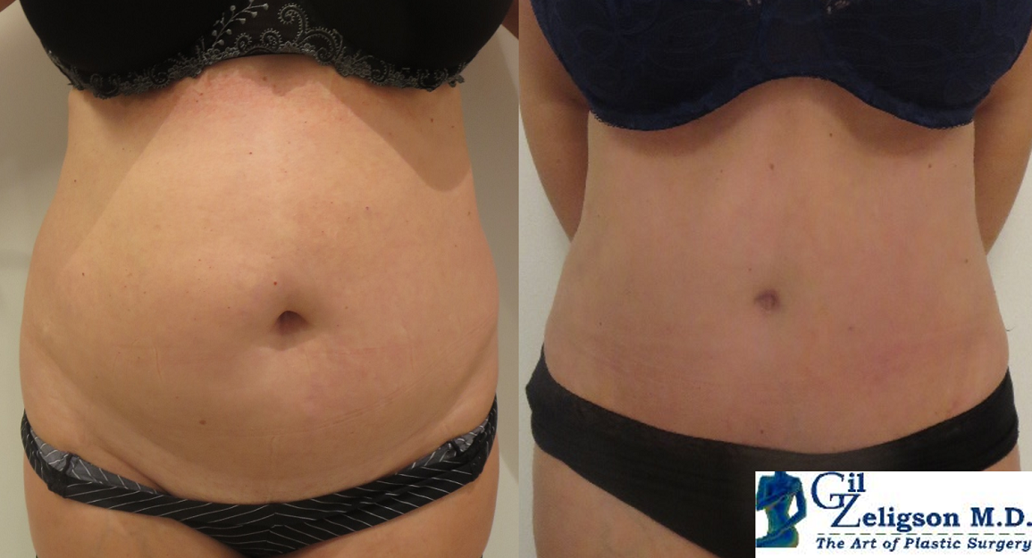 Dr. Gil Zeligson - Tummy Tuck Abdomino plasty