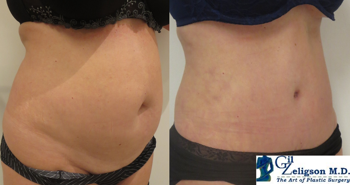 Dr. Gil Zeligson - Tummy Tuck Abdomino plasty