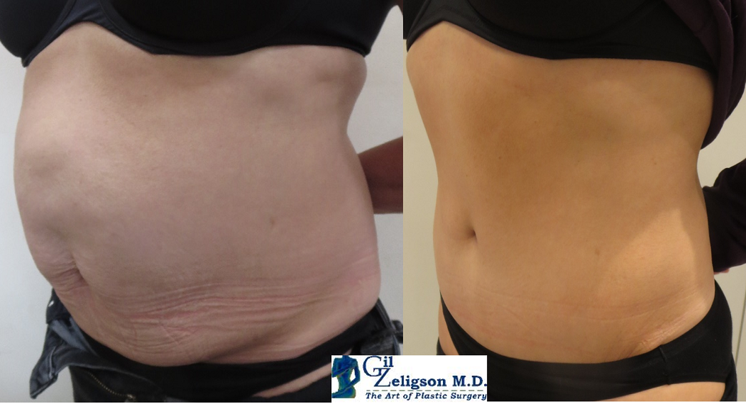 Dr. Gil Zeligson - Tummy Tuck Abdomino plasty