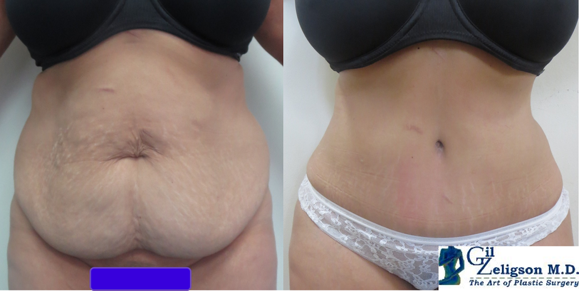 Dr. Gil Zeligson - Tummy Tuck Abdomino plasty