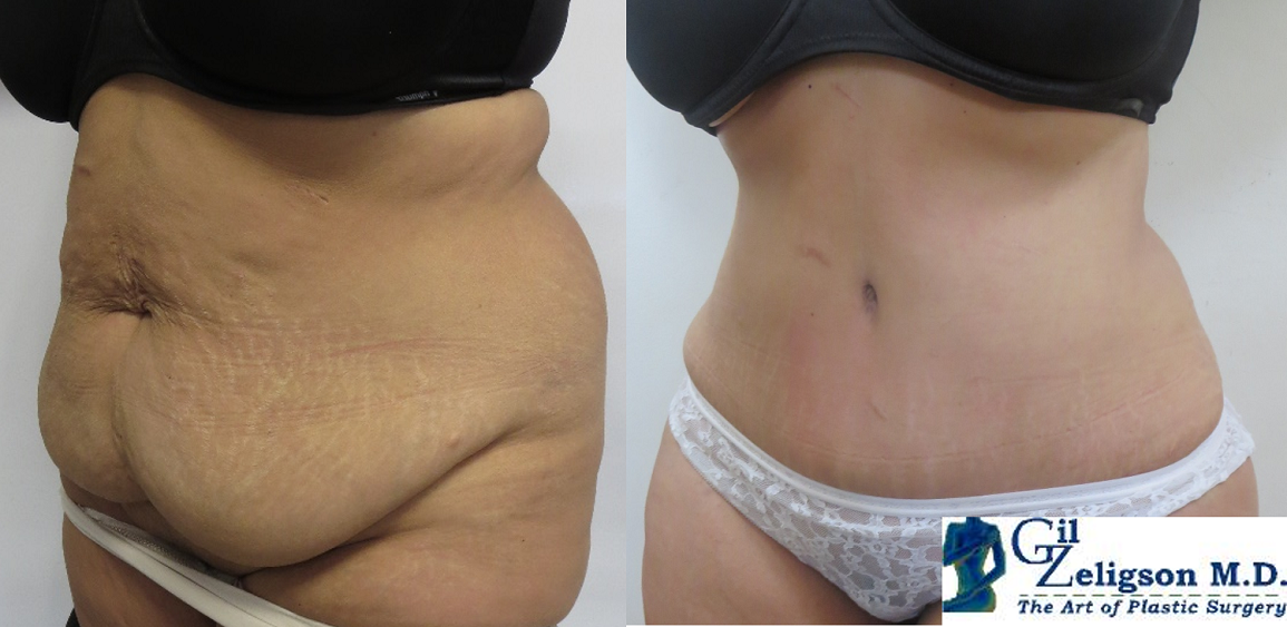 Dr. Gil Zeligson - Tummy Tuck Abdomino plasty