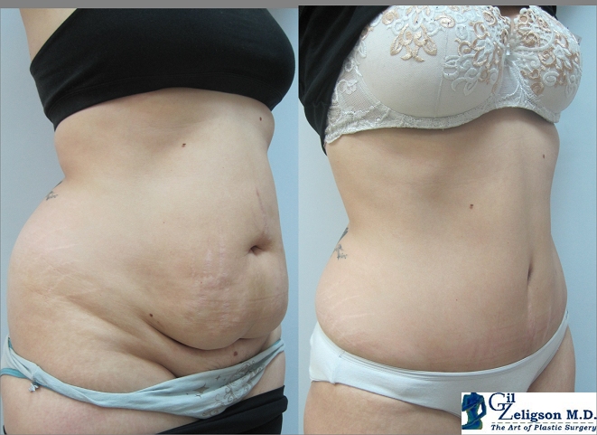 Dr. Gil Zeligson - Tummy Tuck Abdomino plasty