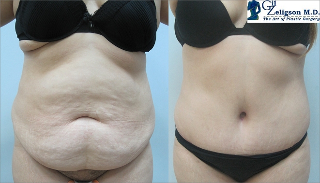 Dr. Gil Zeligson - Tummy Tuck Abdomino plasty