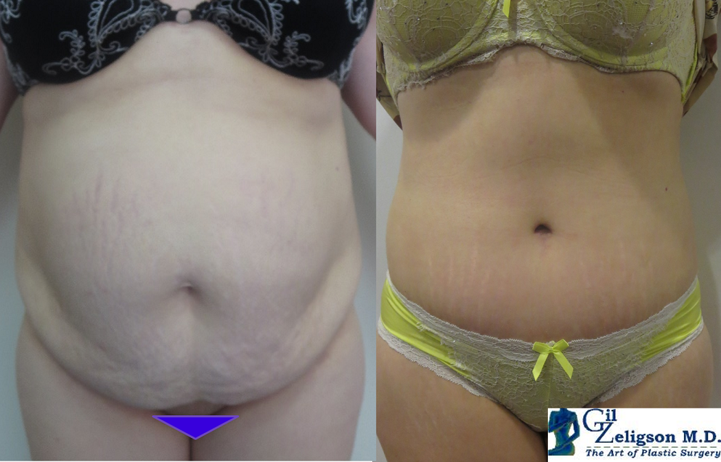 Dr. Gil Zeligson - Tummy Tuck Abdomino plasty
