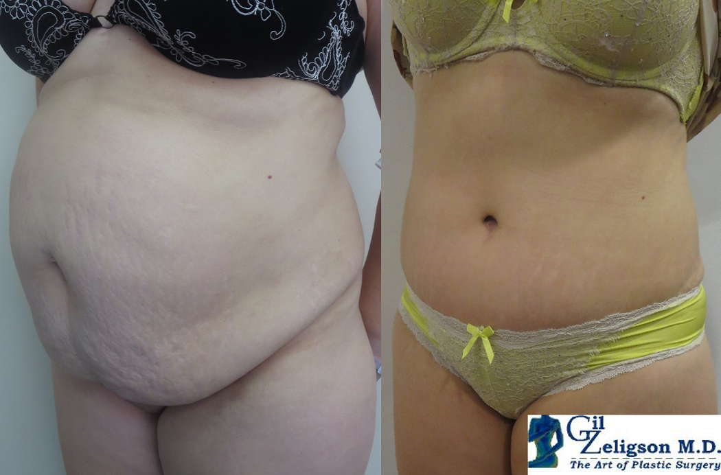Dr. Gil Zeligson - Tummy Tuck Abdomino plasty