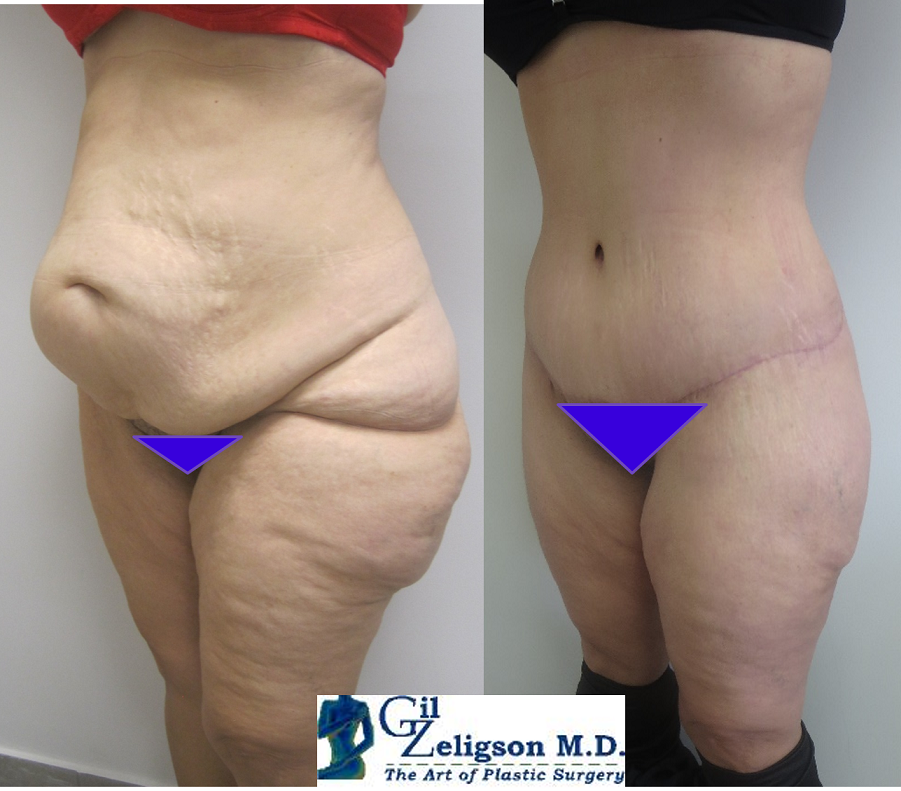 Dr. Gil Zeligson - Tummy Tuck Abdomino plasty