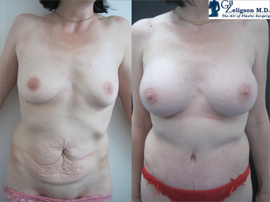 Dr. Gil Zeligson - Tummy Tuck Abdomino plasty