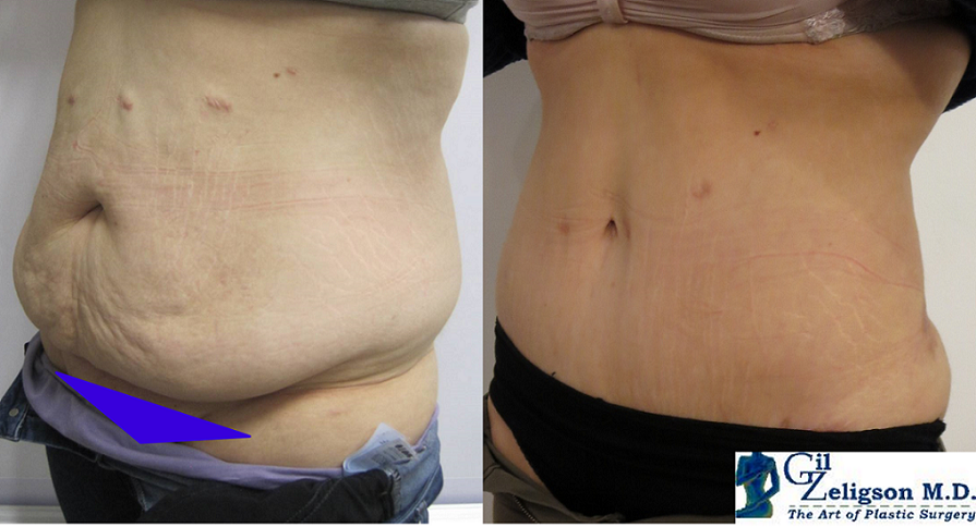 Dr. Gil Zeligson - Tummy Tuck Abdomino plasty