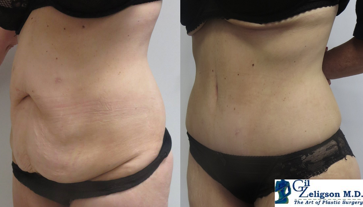 Dr. Gil Zeligson - Tummy Tuck Abdomino plasty