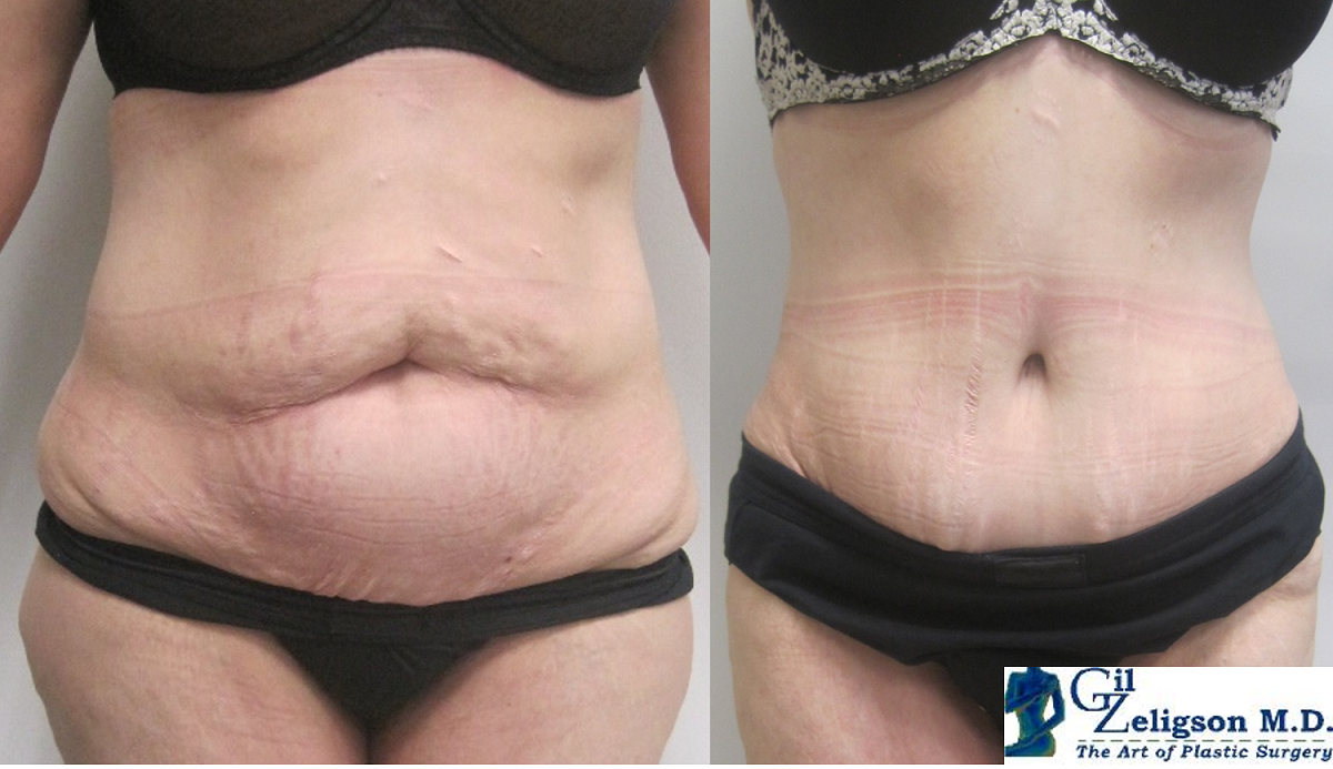 Dr. Gil Zeligson - Tummy Tuck Abdomino plasty