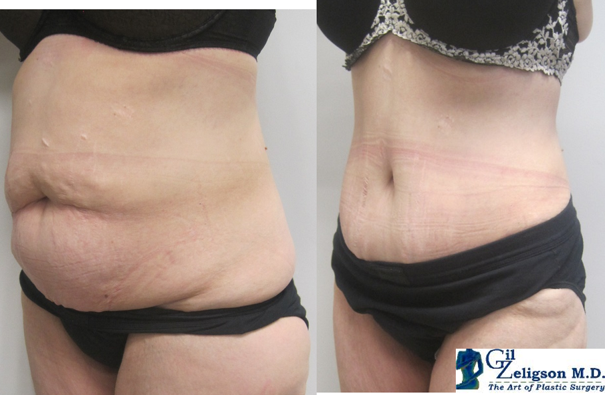 Dr. Gil Zeligson - Tummy Tuck Abdomino plasty