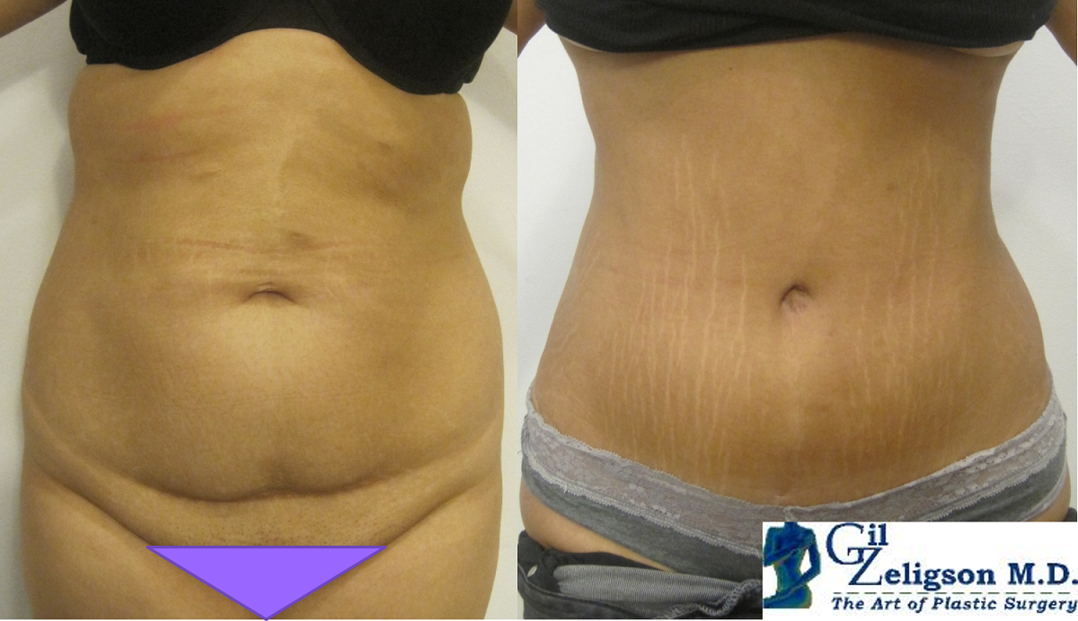Dr. Gil Zeligson - Tummy Tuck Abdomino plasty