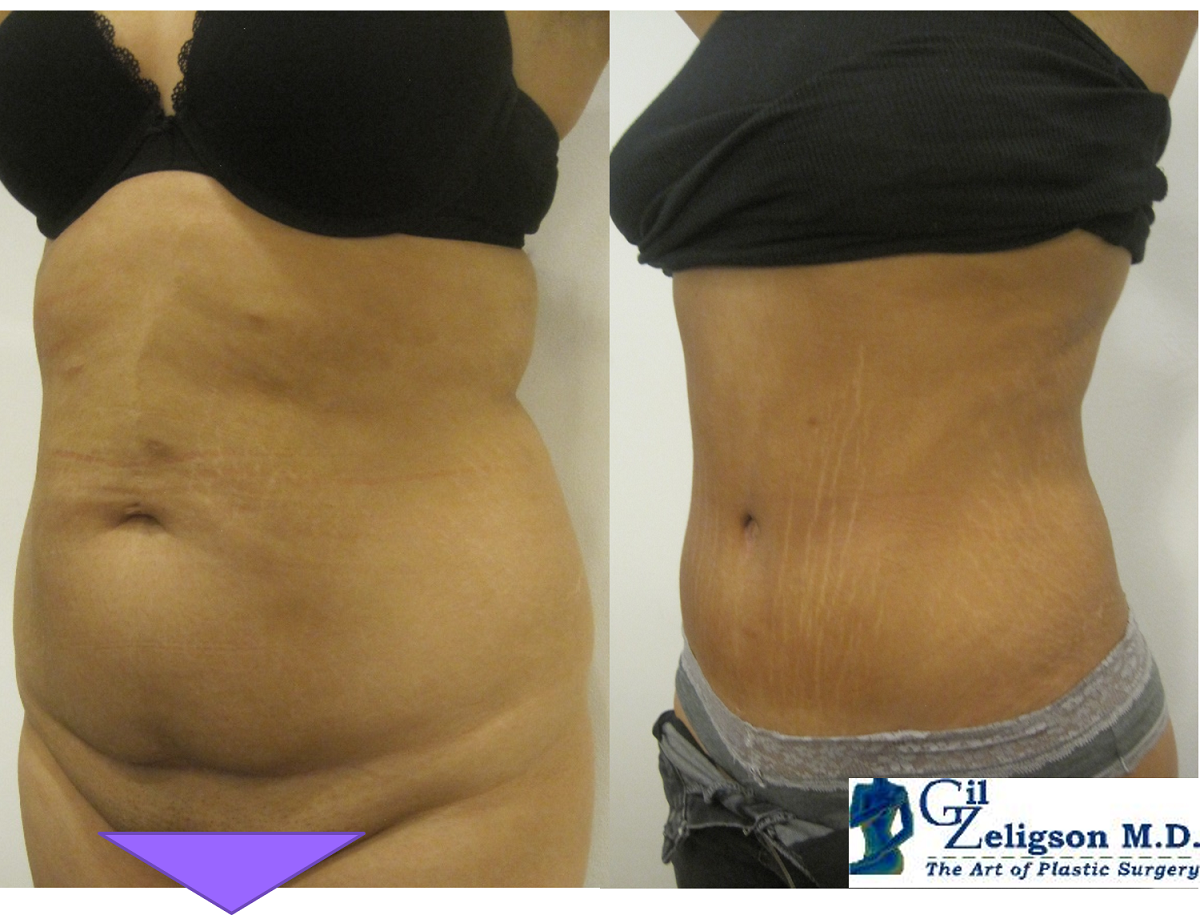 Dr. Gil Zeligson - Tummy Tuck Abdomino plasty