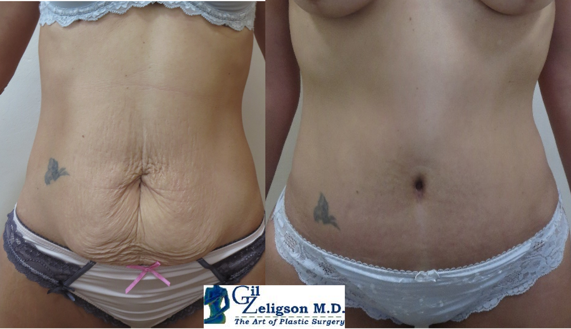 Dr. Gil Zeligson - Tummy Tuck Abdomino plasty