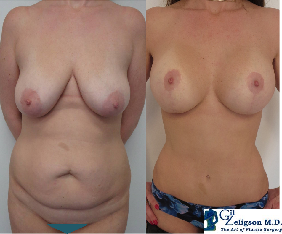 Dr. Gil Zeligson - Mastopexy + Augmentation
