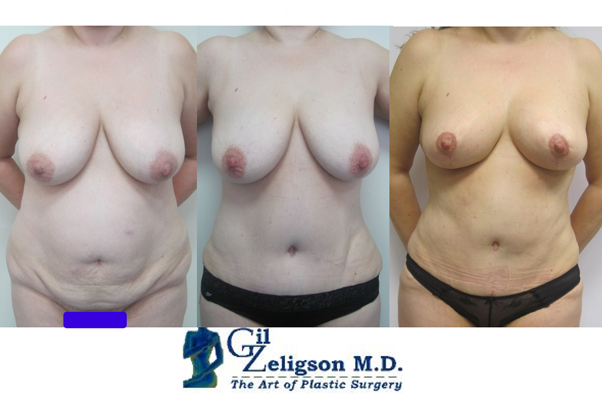 Dr. Gil Zeligson - Tummy Tuck Abdomino plasty
