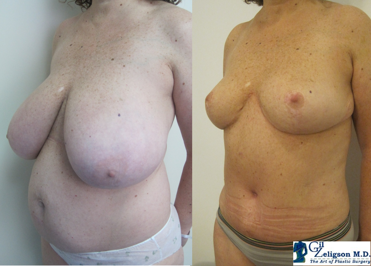 Dr. Gil Zeligson - Breast Reduction