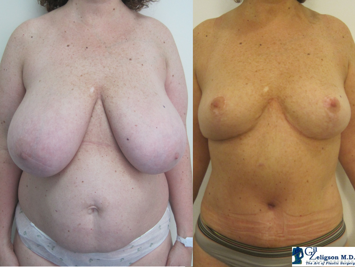 Dr. Gil Zeligson - Tummy Tuck Abdomino plasty