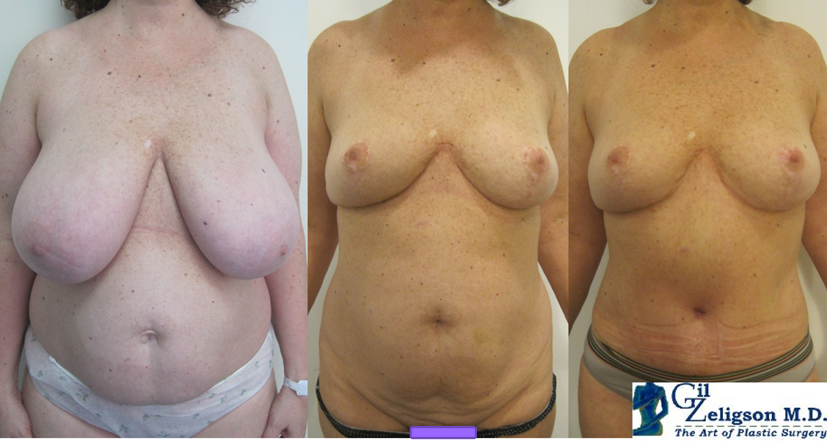 Dr. Gil Zeligson - Breast Reduction