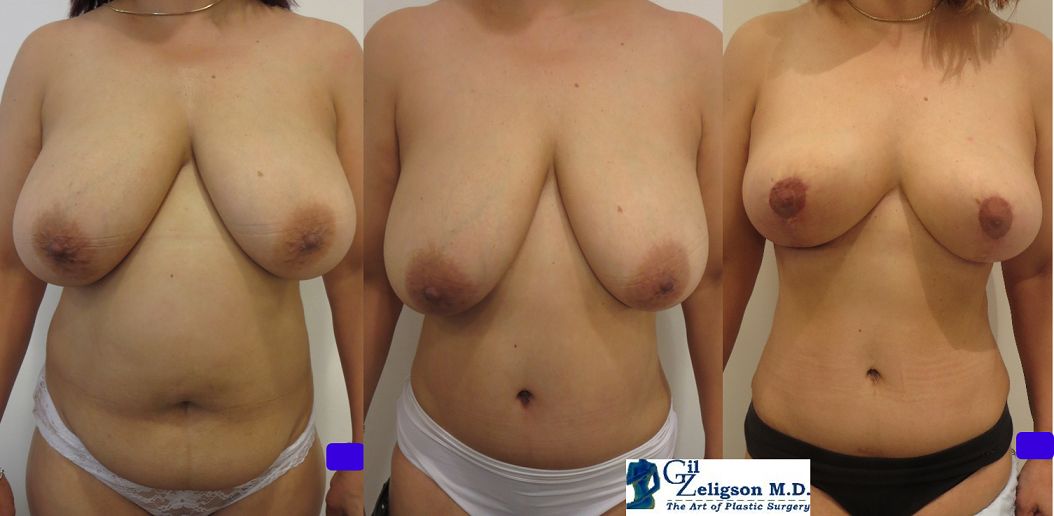 Dr. Gil Zeligson - Breast Reduction