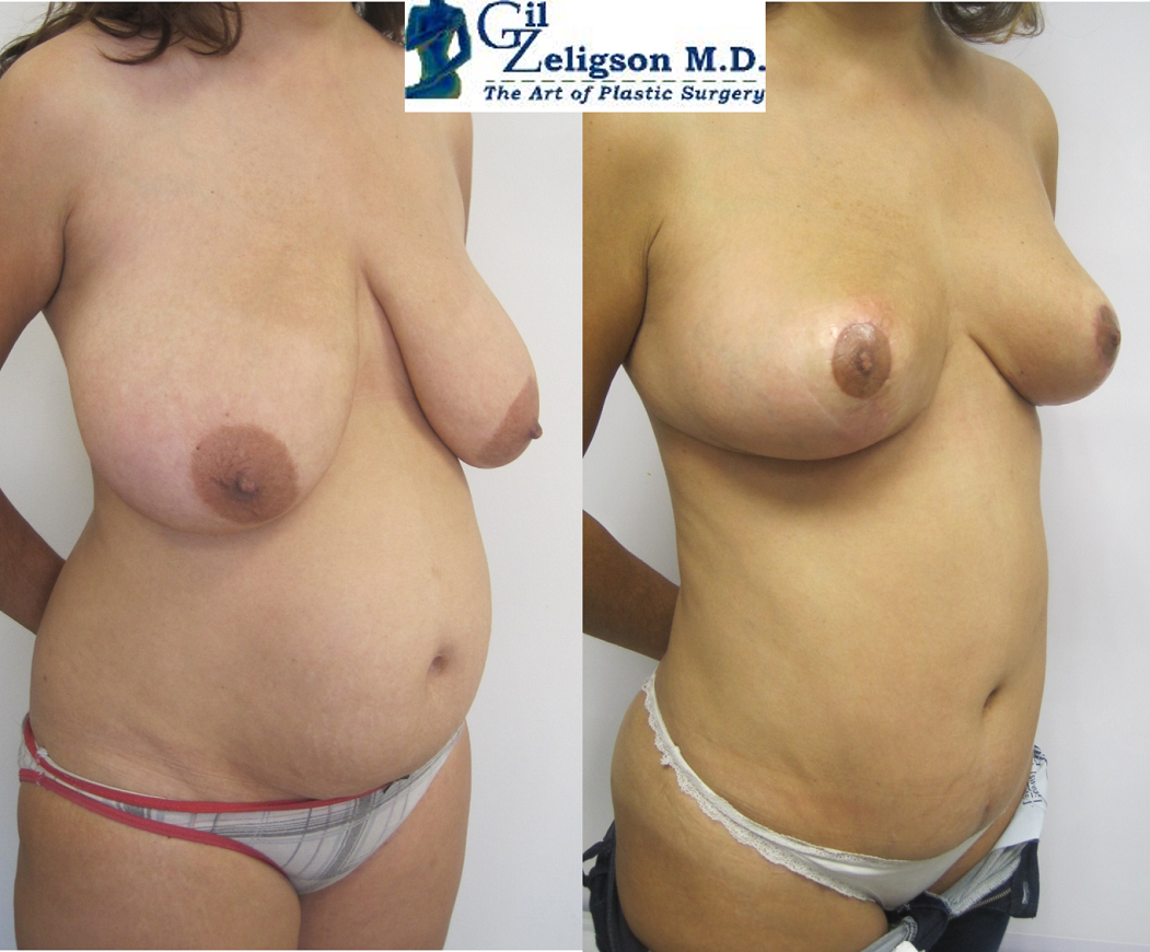Dr. Gil Zeligson - Breast Reduction
