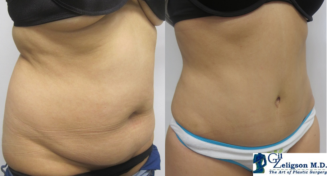 Dr. Gil Zeligson - Tummy Tuck Abdomino plasty