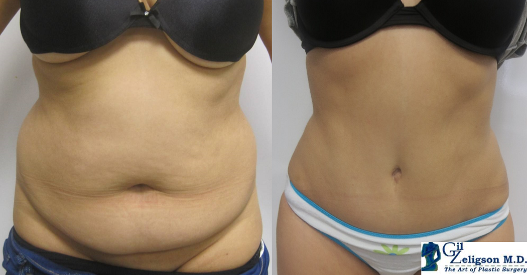 Dr. Gil Zeligson - Tummy Tuck Abdomino plasty