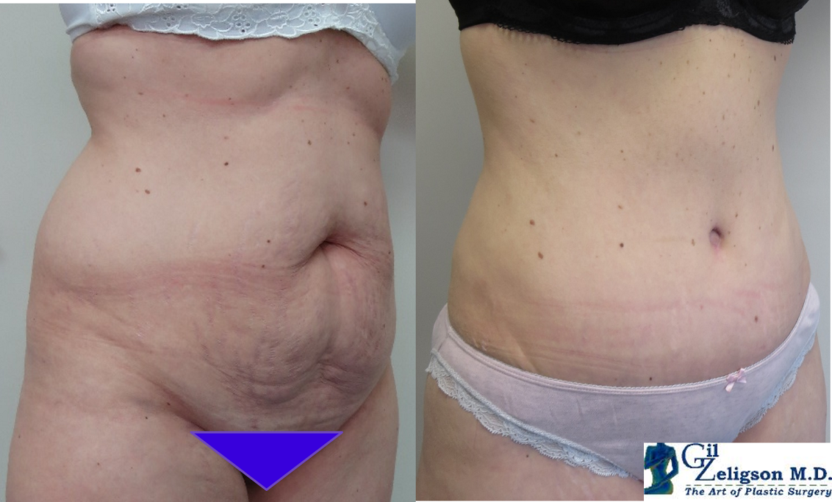 Dr. Gil Zeligson - Tummy Tuck Abdomino plasty
