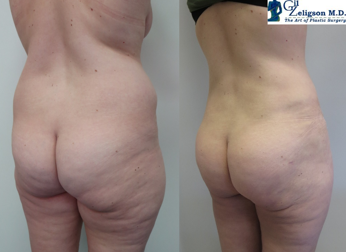 Dr. Gil Zeligson - Tummy Tuck Abdomino plasty