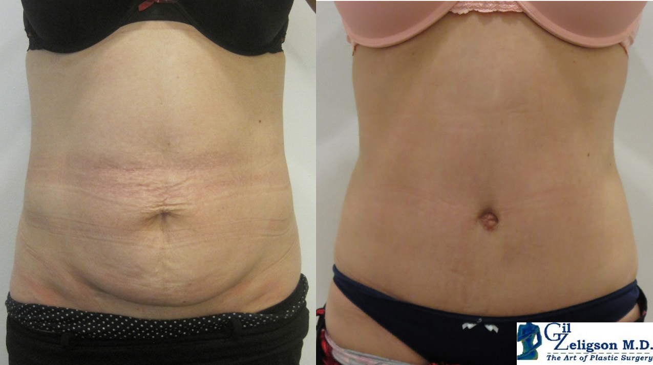 Dr. Gil Zeligson - Tummy Tuck Abdomino plasty
