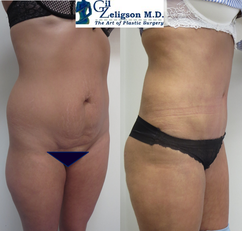 Dr. Gil Zeligson - Liposuction