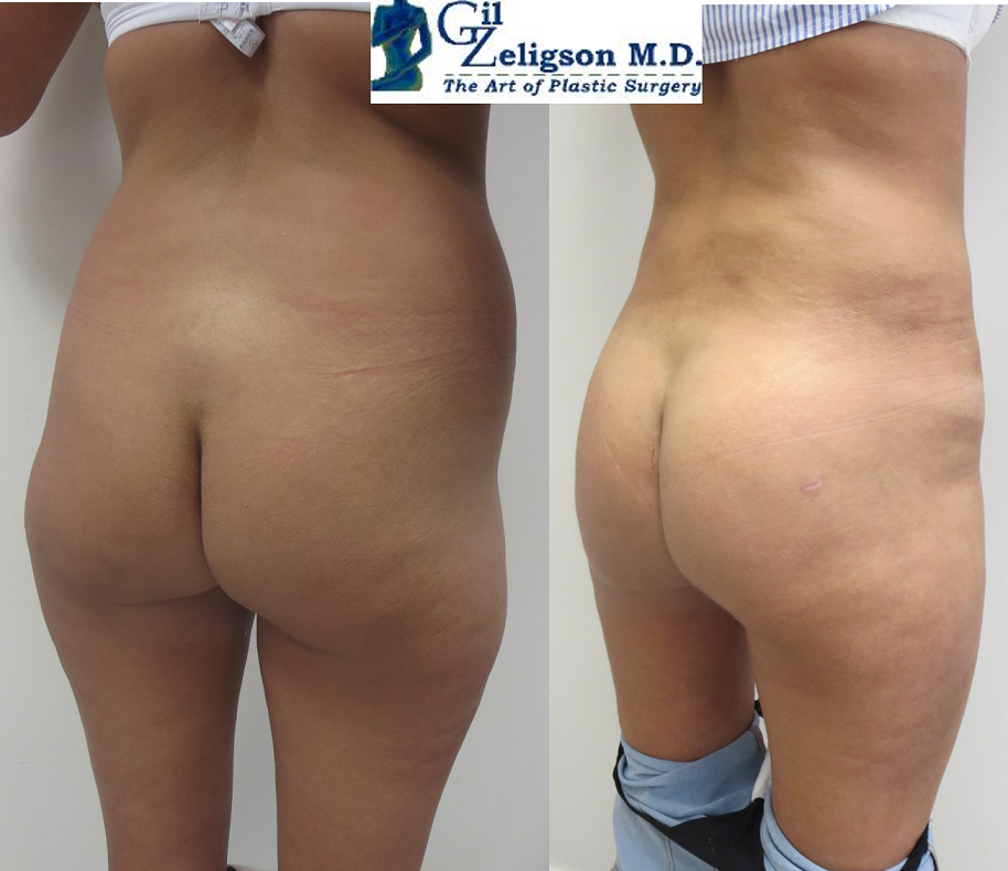 Dr. Gil Zeligson - Tummy Tuck Abdomino plasty