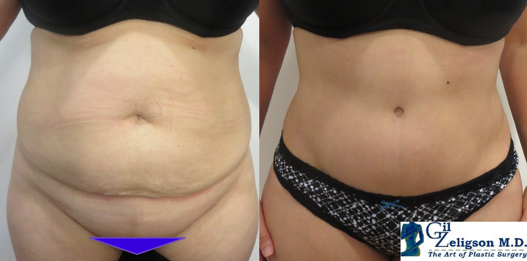 Dr. Gil Zeligson - Tummy Tuck Abdomino plasty