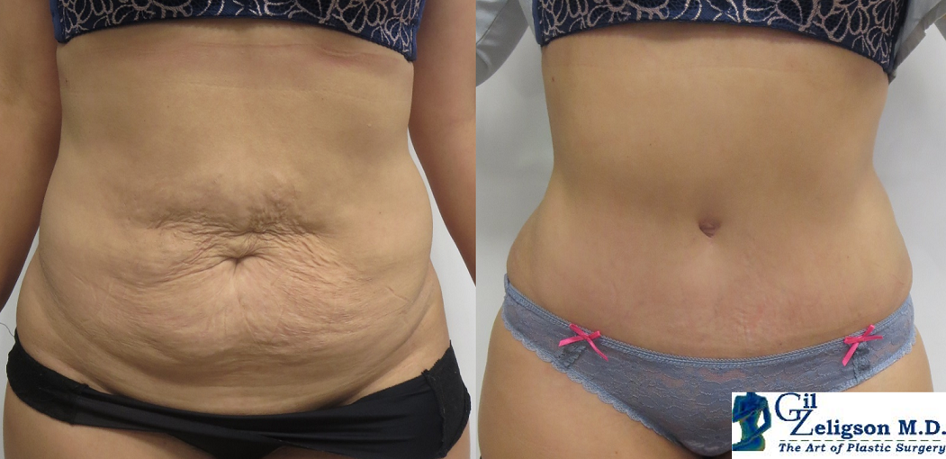 Dr. Gil Zeligson - Tummy Tuck Abdomino plasty