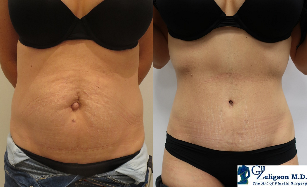 Dr. Gil Zeligson - Tummy Tuck Abdomino plasty