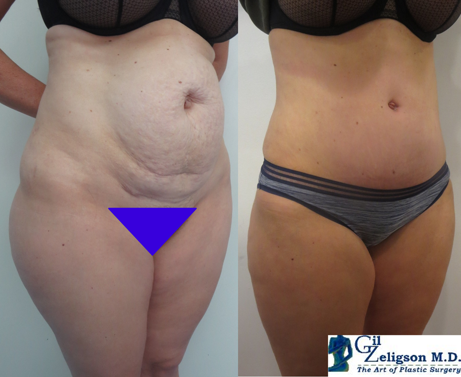 Dr. Gil Zeligson - Tummy Tuck Abdomino plasty