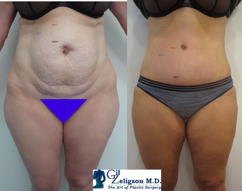 Dr. Gil Zeligson - Tummy Tuck Abdomino plasty
