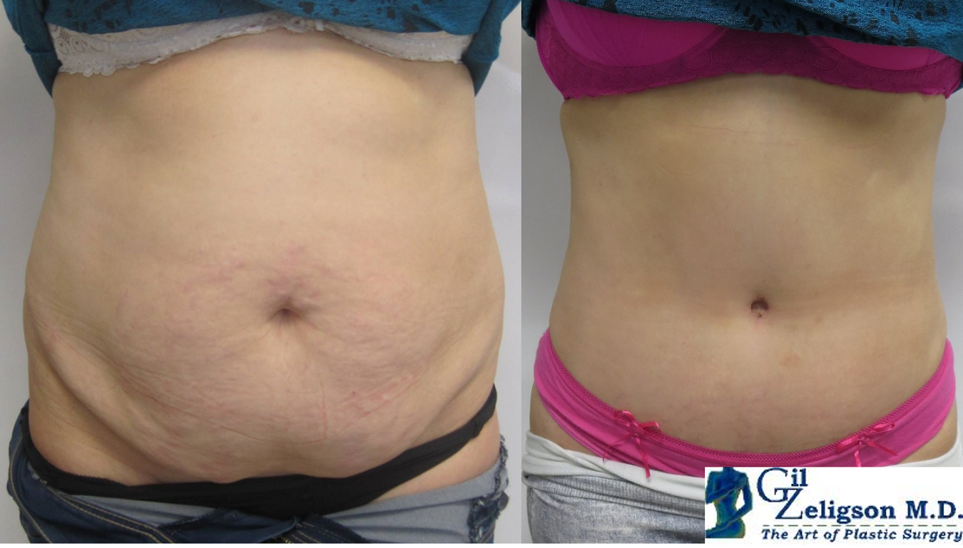 Dr. Gil Zeligson - Tummy Tuck Abdomino plasty