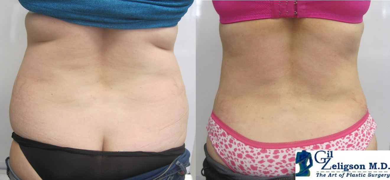 Dr. Gil Zeligson - Tummy Tuck Abdomino plasty