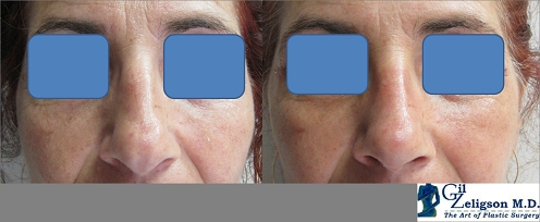 Dr. Gil Zeligson - Rhinoplasty