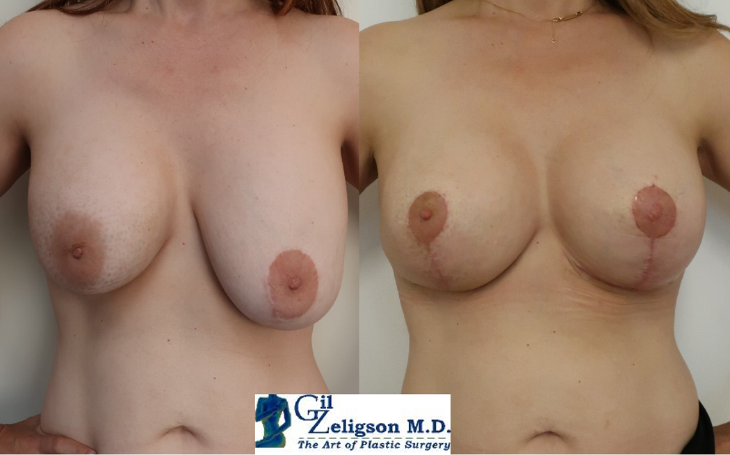 Dr. Gil Zeligson - Breast Asymmetry Correction