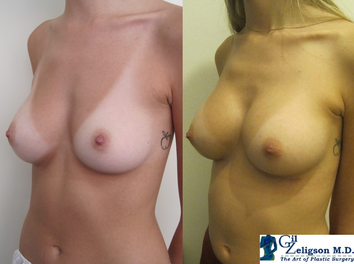 Dr. Gil Zeligson - Breast Asymmetry Correction