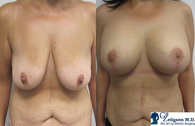 Dr. Gil Zeligson - Mastopexy + Augmentation