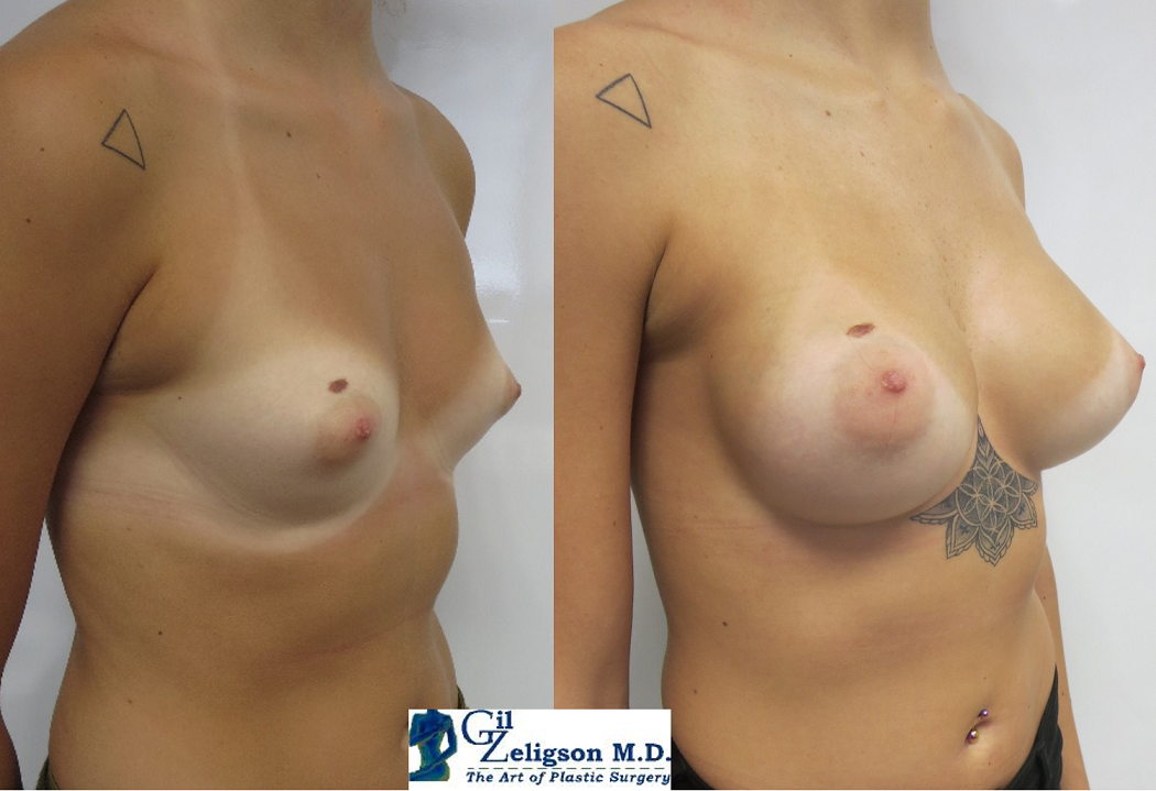 Dr. Gil Zeligson - Breast augmentation