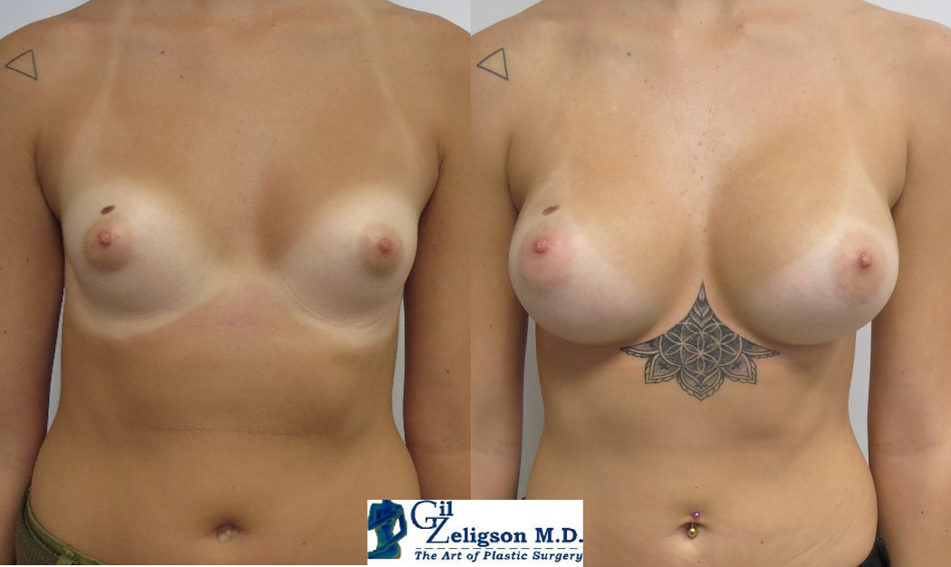 Dr. Gil Zeligson - Breast augmentation