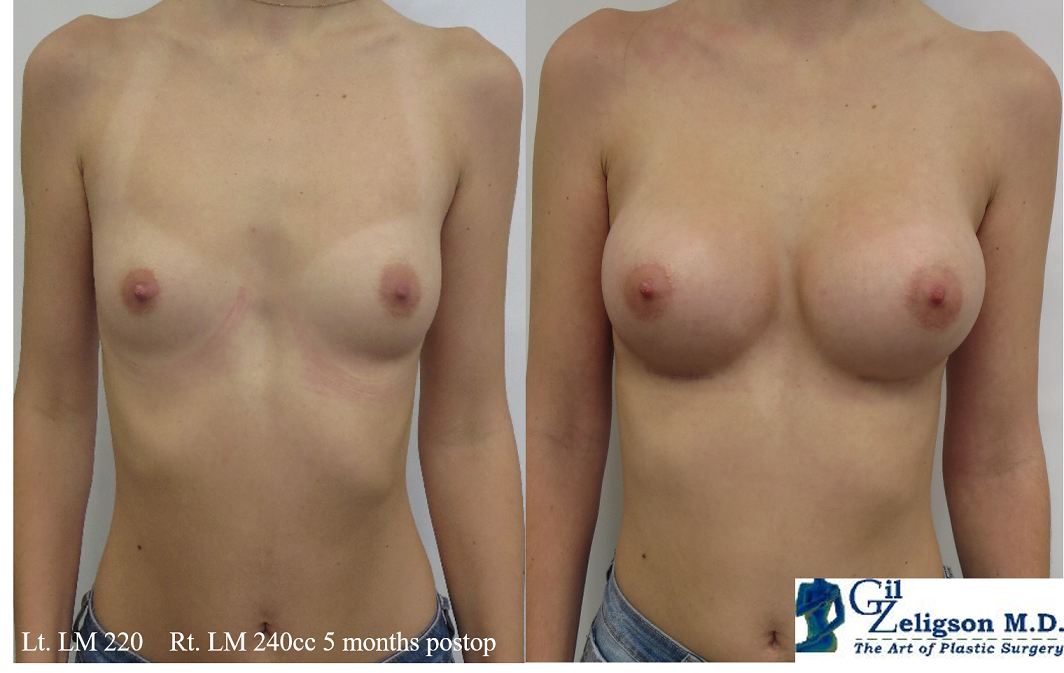 Dr. Gil Zeligson - Breast augmentation