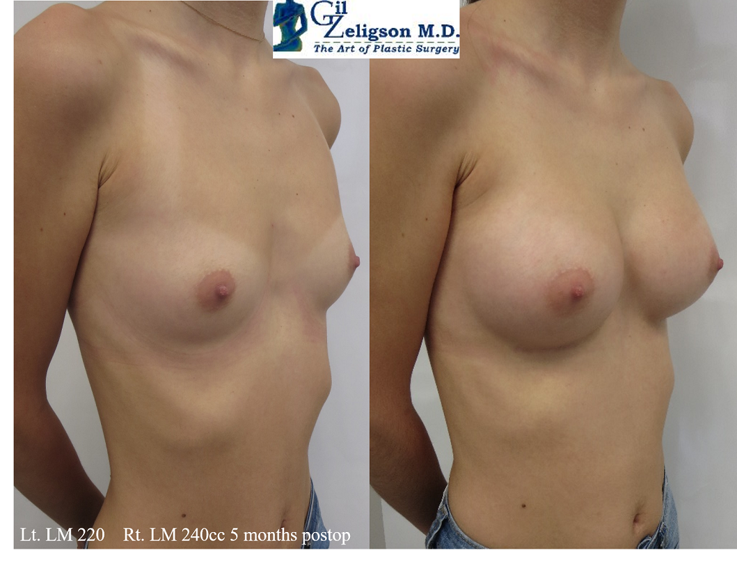 Dr. Gil Zeligson - Breast augmentation
