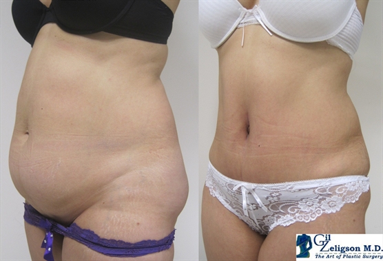 Dr. Gil Zeligson - Tummy Tuck Abdomino plasty