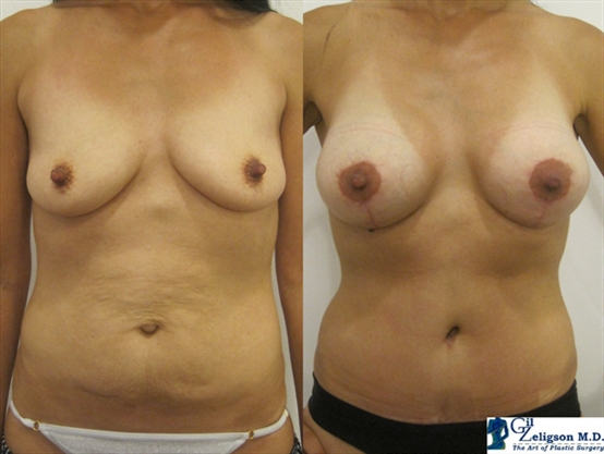 Dr. Gil Zeligson - Tummy Tuck Abdomino plasty